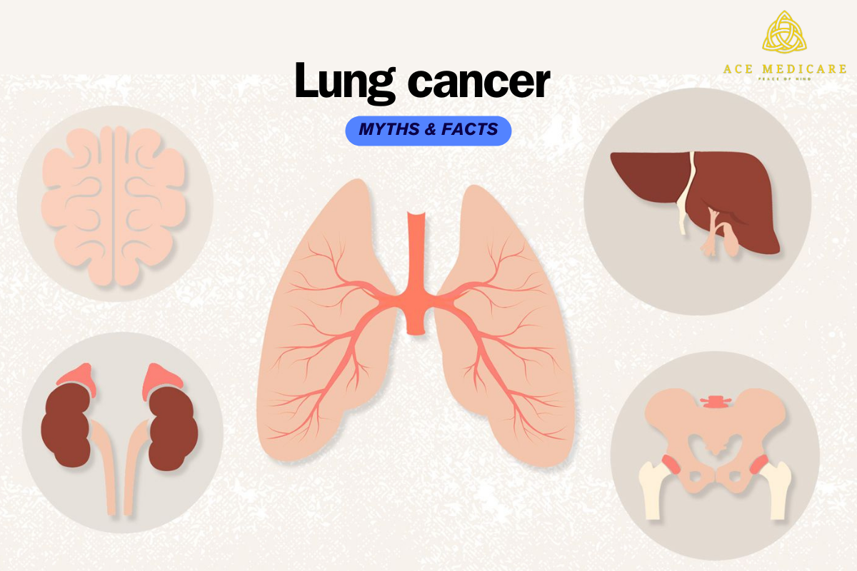 Breaking Down the Myths and Facts About Lung Cancer